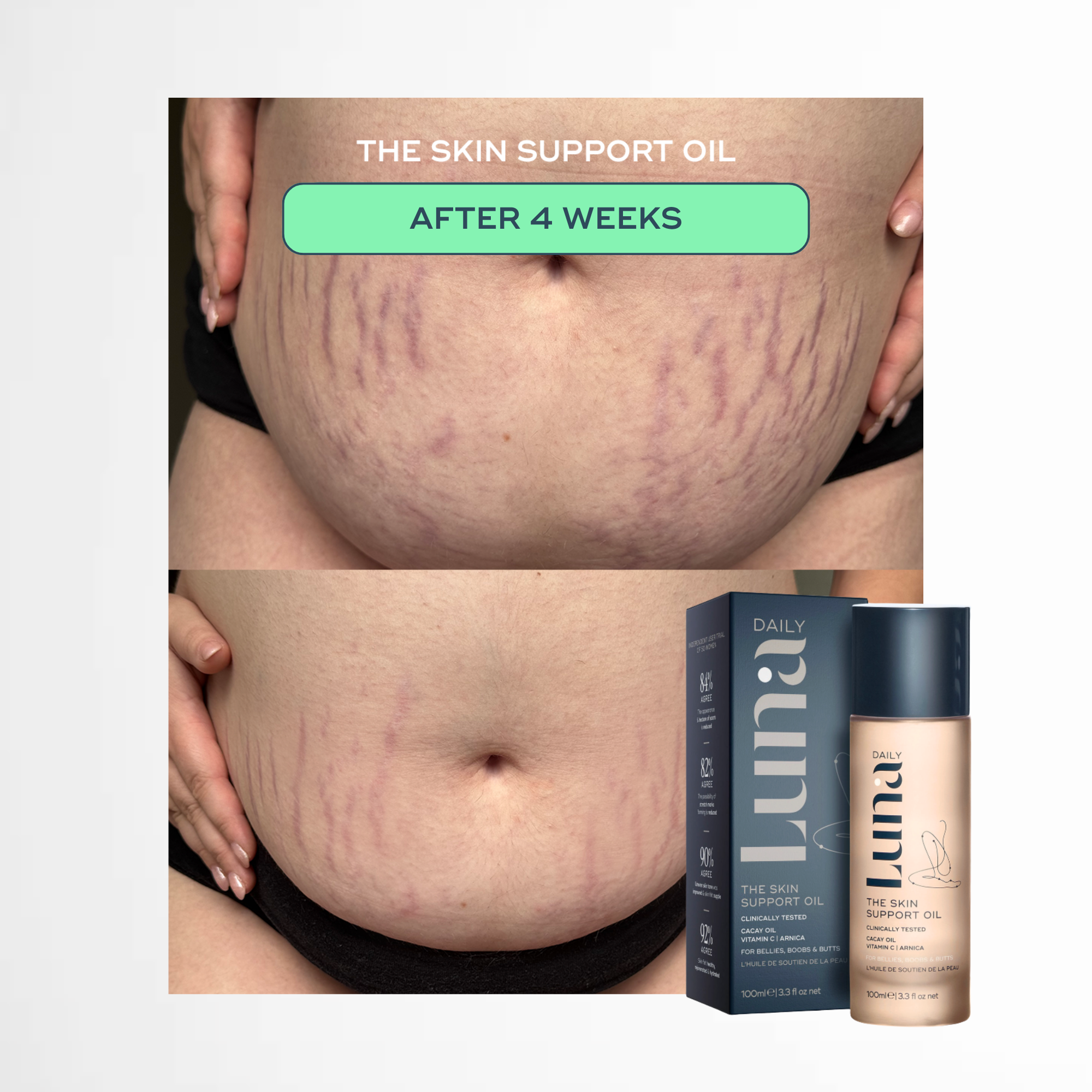 The Skin Support Oil - For Stretch Marks, Hyperpigmentation + Uneven Skin Texture