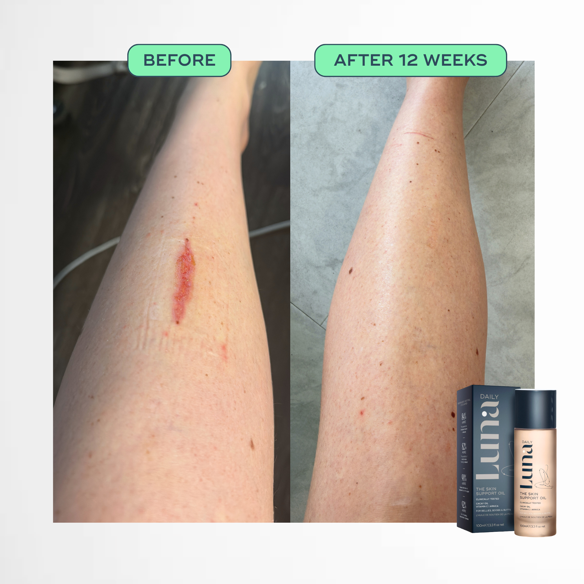 The Skin Support Oil - For Stretch Marks, Hyperpigmentation + Uneven Skin Texture