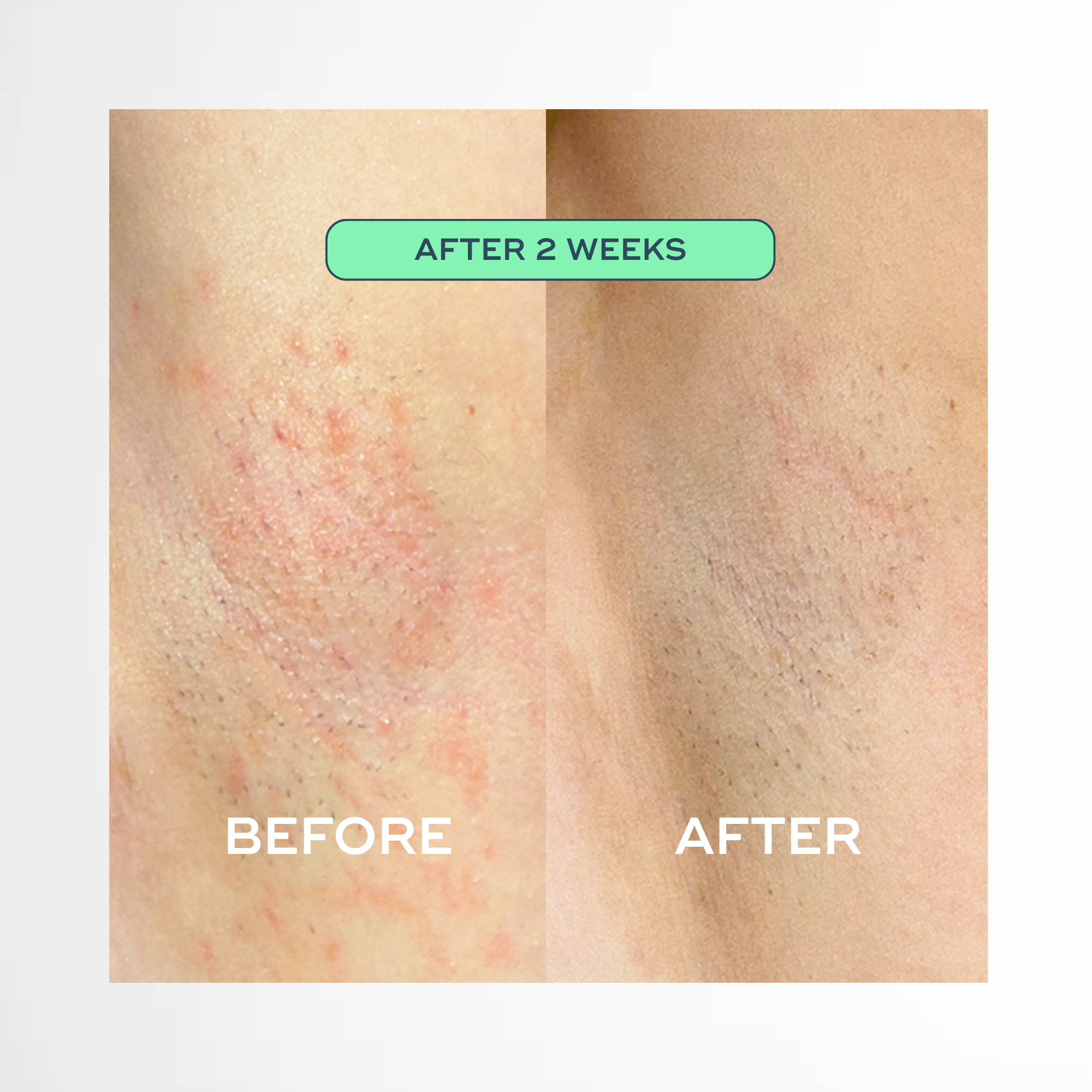The Everything Oil - For Ingrowns & Bumps