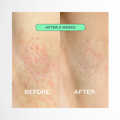 The Everything Oil - For Ingrowns & Bumps