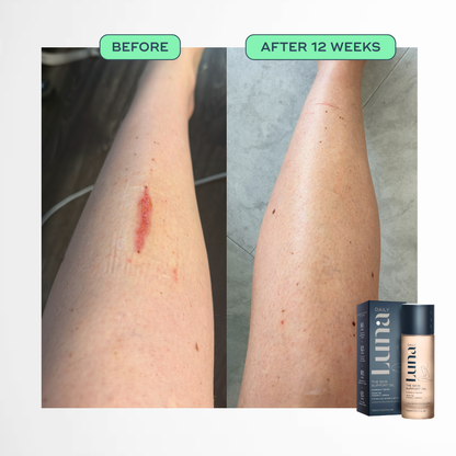 The Skin Support Oil - For Stretch Marks, Hyperpigmentation + Uneven Skin Texture