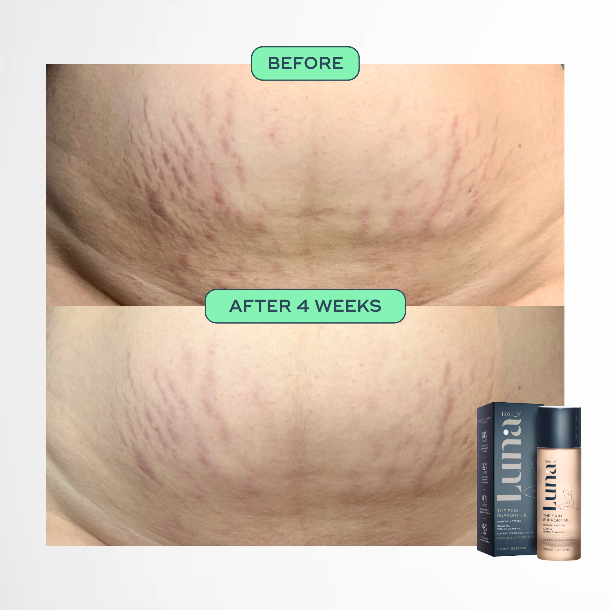 The Skin Support Oil - For Stretch Marks, Hyperpigmentation + Uneven Skin Texture