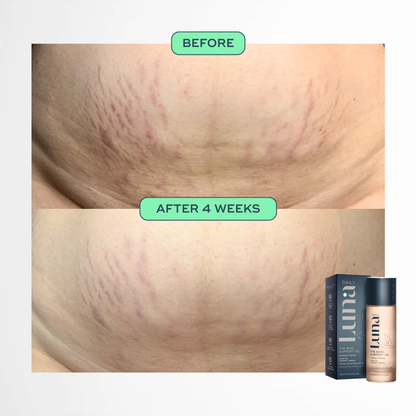 The Skin Support Oil - For Stretch Marks, Hyperpigmentation + Uneven Skin Texture