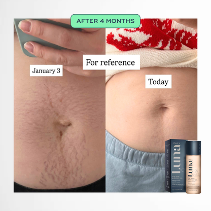 The Skin Support Oil - For Stretch Marks, Hyperpigmentation + Uneven Skin Texture